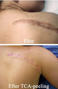 Gammalt pigmenterat ärr på ryggen före TCA-peeling. Efter peelingen blev det ljusare och lägre, i nivå med huden