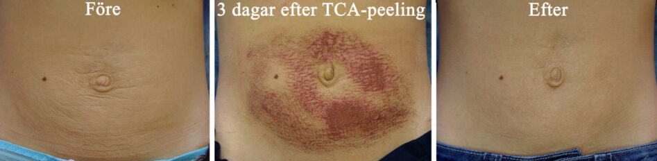 Hudbristningar och slapp hud på buken före TCA-peeling, efter 3 dagar och efter läkning