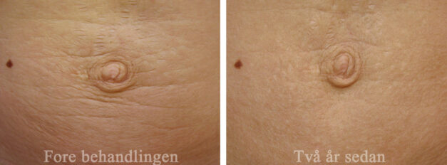 bristningar före och efter bilder: slapp hud på buken runt naveln före och 2 år efter TCA-peeling. Huden har dragit åt och är fortfarande tonad efter 2 år