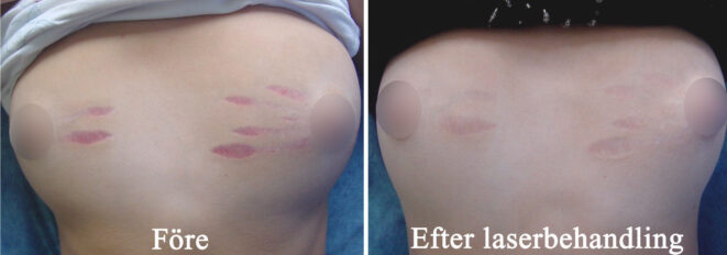 bristningar före och efter bilder: röda färska bristningar på brösten under puberteten före och efter vaskulär laserbehandling med pulsad färgämneslaser (PDL)