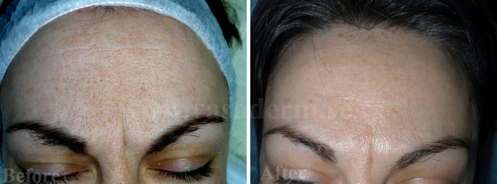 Förstorade porer i ansiktet före och efter behandling. Bilden efter microneedling visar en signifikant förbättring och förminskning av porerna