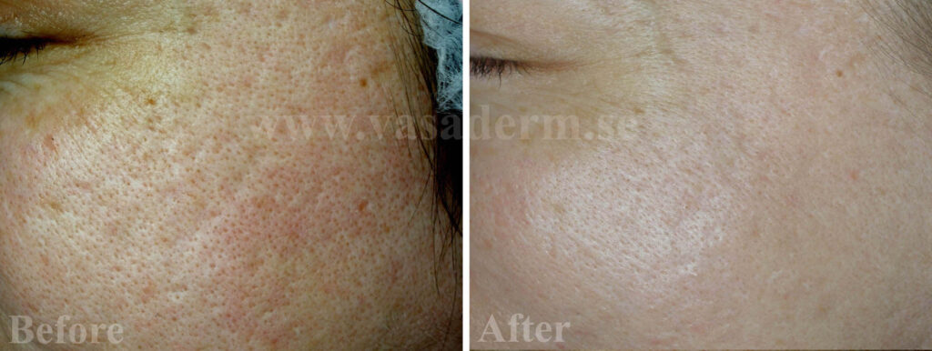 Förstorade porer i ansiktet före och efter kryobehandling. Signifikant krympning av porer med kryoterapi och kräm Elicina