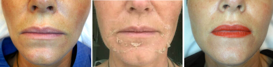 Ansiktshudens tillstånd före TCA-peeling, under exfoliering och efter peeling