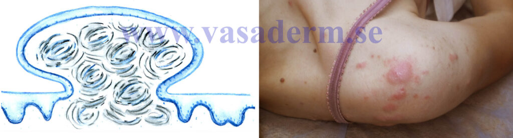 schematisk bild och illustrativt foto av acne keloider på axlar