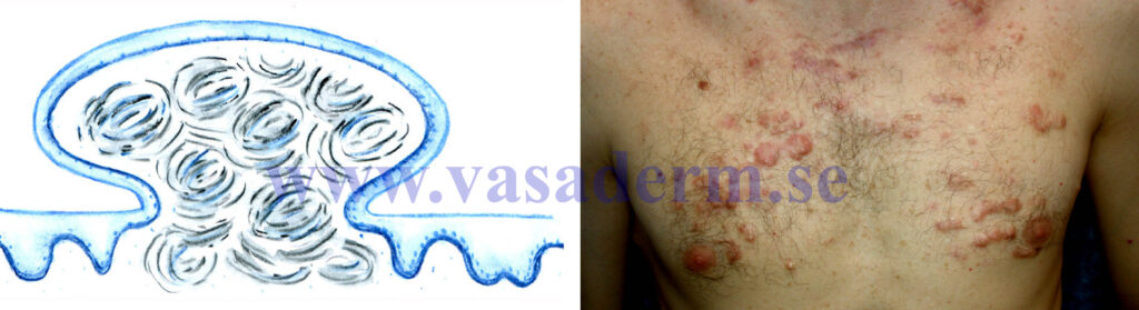 schematisk bild och illustrativt foto av acne keloid på bröstet