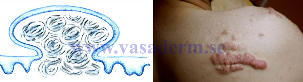 schematisk bild och illustrativt foto av acne keloid på ryggen