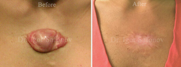Återfall av ett keloidärr på bröstet efter 2 kirurgiska borttagningar. Foto av återkommande keloidärr före och efter vår behandling