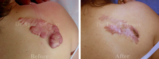Foto av ett återkommande keloidärr i skulderbladsområdet före och efter vår behandling