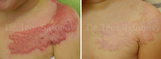 Aktiv keloid ärrbildning på bröst och axlar hos ett barn efter en brännskada. Foto före och efter behandling av brännskada ärr