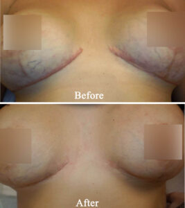 Grova hypertrofiska ärr på brösten efter bröstreduktion före och efter kryokirurgi